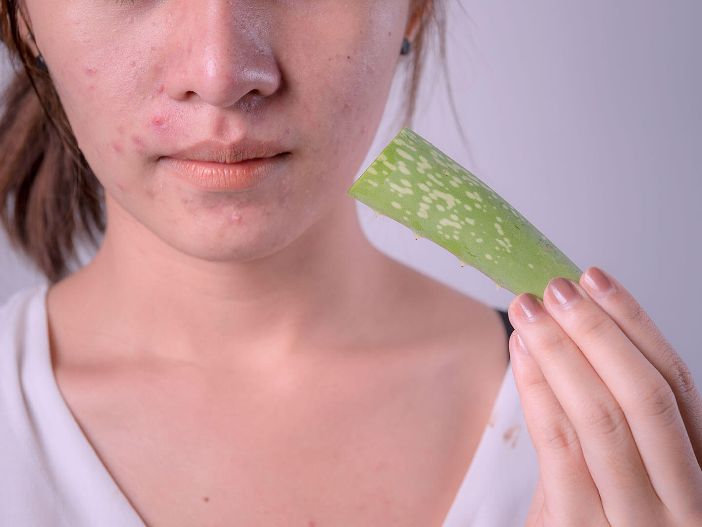 Trị sẹo mụn bằng nha đam thiên nhiên