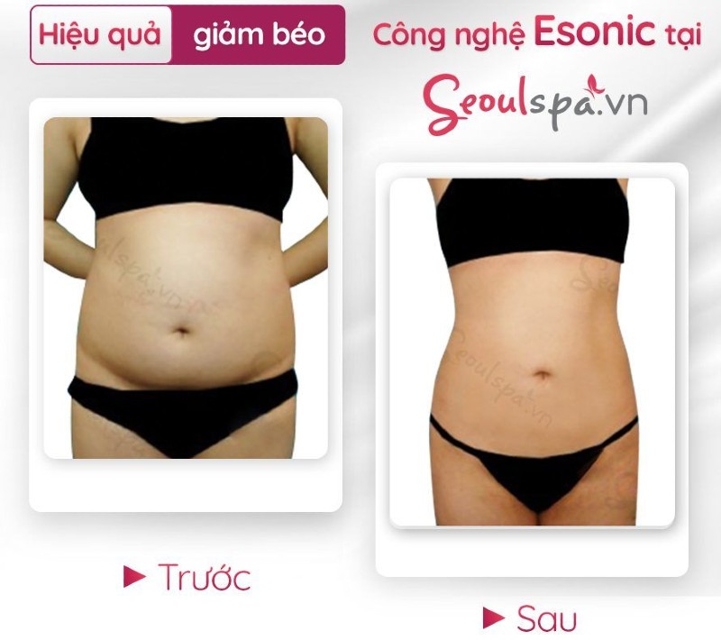 Giảm béo nhanh bằng công nghệ E sonic