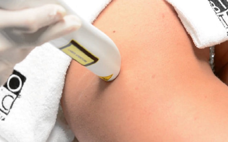 Top 20+ Trị Rạn Da Bằng Laser Bao Nhiêu Tiền Trị rạn da bằng laser bao nhiêu tiền? Có hiệu quả không? 24 Trị rạn da bằng laser không đau, an toàn tuyệt đối
