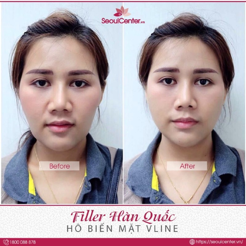 Khi nhắc đến tiêm filler ở đâu an toàn thì cái tên thứ hai không thể bỏ qua chắc chắn đó là bệnh viện thẩm mỹ Seoul Center