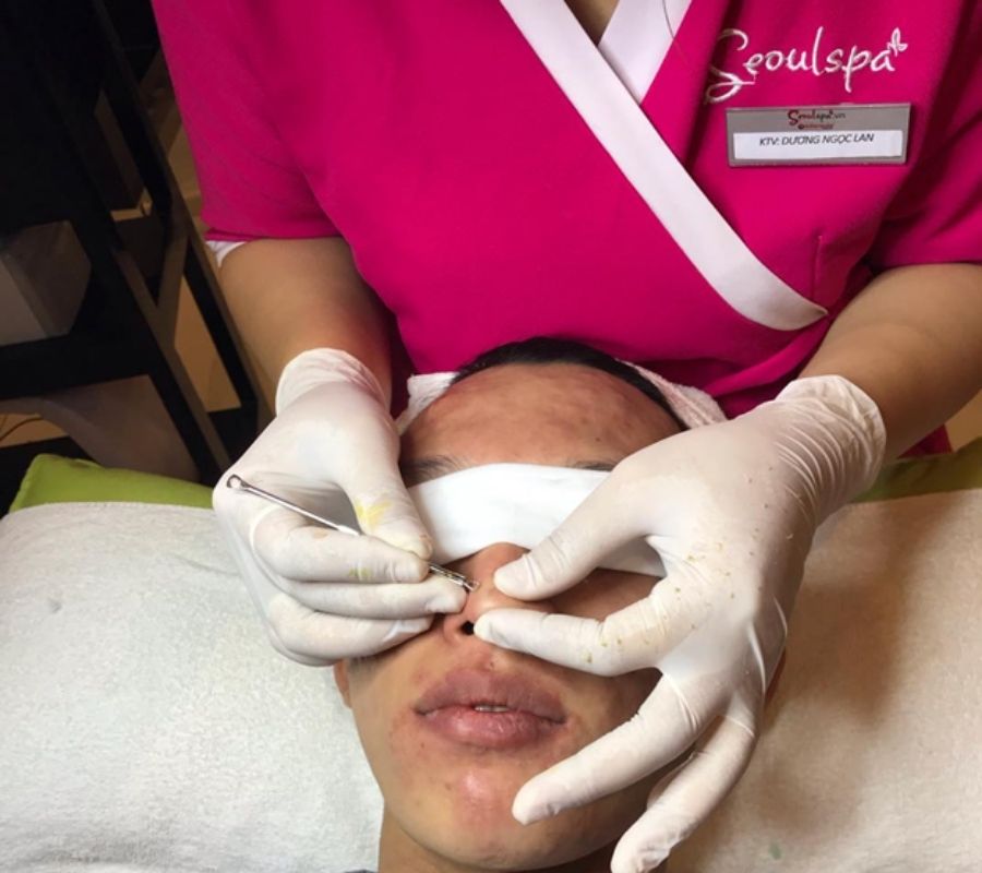 Kỹ thuật viên tiến hành lấy nhân mụn