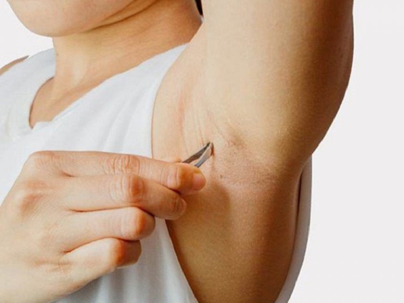 Các biện pháp triệt lông thường ngày thường không mang lại hiệu quả cao