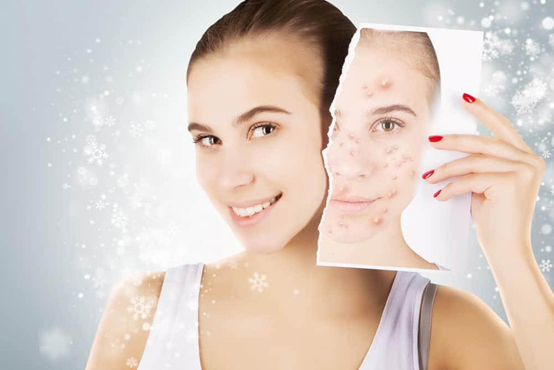 trị mụn bằng laser bao nhiêu tiền