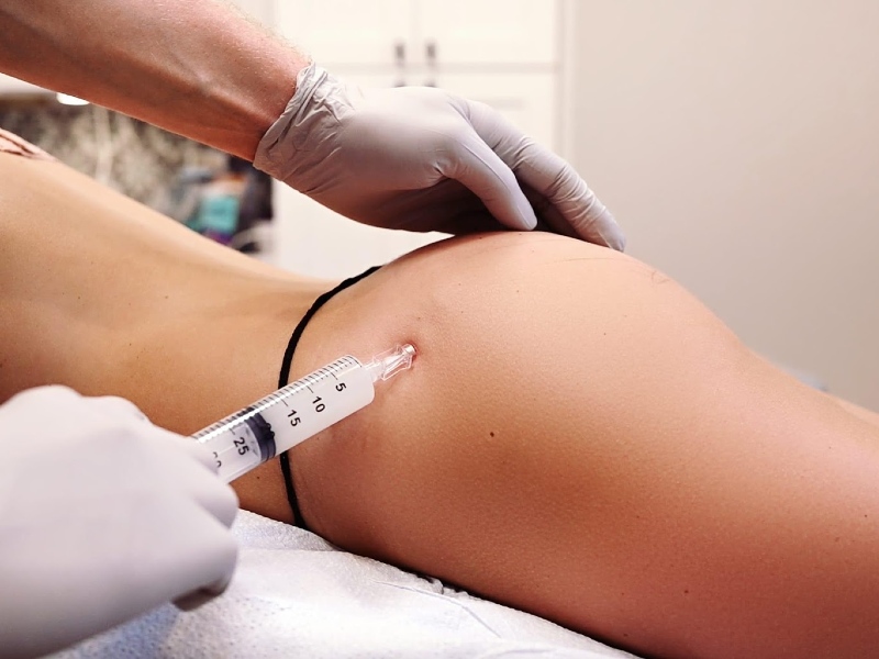 Tiêm filler độn mông được xem là một trong những phương pháp làm đẹp an toàn, không xâm lấn được ưa chuộng nhất trong vài năm trở lại đây