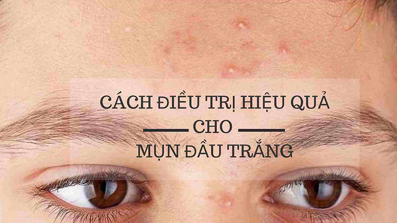 Top 20+ Cách Trị Mụn Đầu Trắng Ẩn Dưới Da Cách trị mụn đầu trắng ẩn dưới da siêu hiệu quả bằng tự nhiên 53 Những cách trị mụn đầu trắng