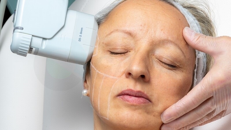 Công nghệ Thermage điều trị cả vùng cổ cùng nhiều vùng khác trên cơ thể