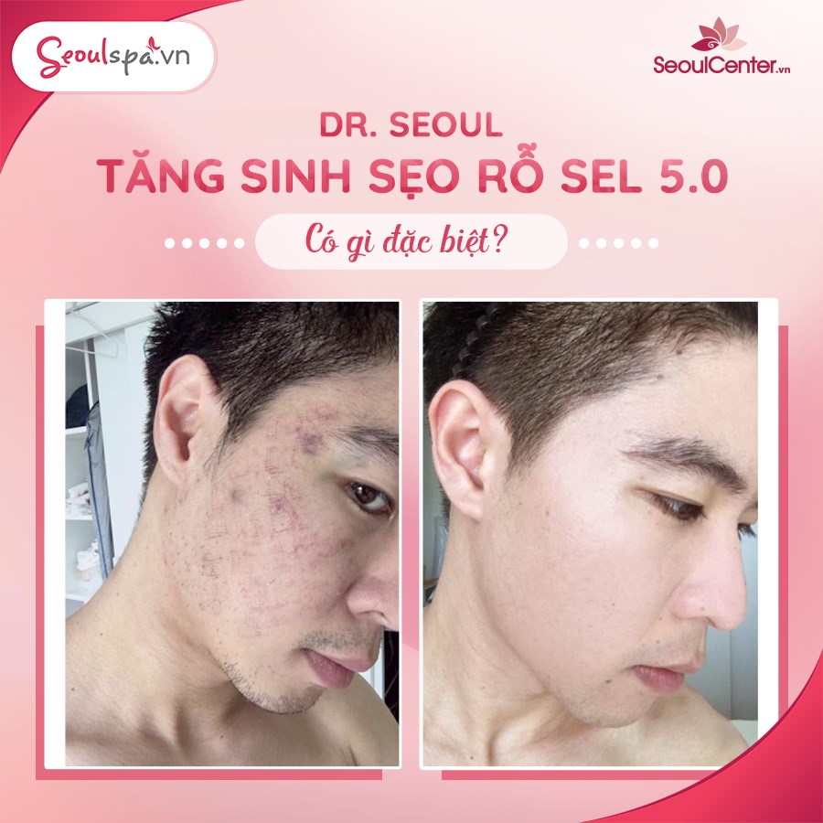 Top 20+ Mặt Bị Rỗ Có Chữa Được Không “Tuyệt chiêu” giúp phục hồi da mặt bị rỗ hiệu quả | SeoulSpa.Vn 69 Phương pháp DR. SEL 5.0 được nghiên cứu bởi các bác sĩ tại Thẩm mỹ viện Seoul Spa