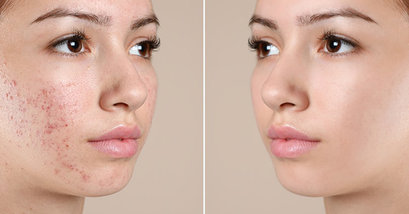 Trị mụn laser có hiệu quả không?