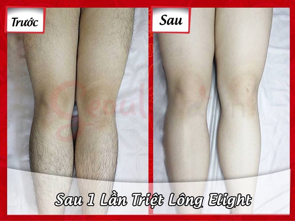 Kết quả triệt lông chân của khách hàng Thẩm mỹ viện Seoul Spa