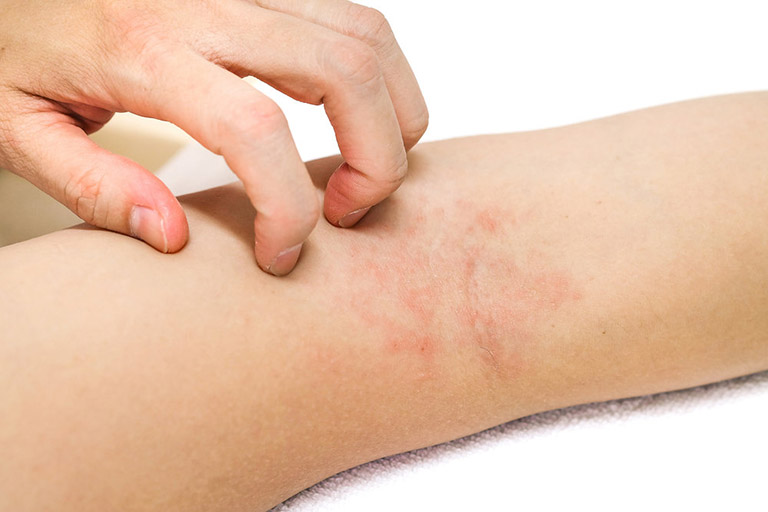 Dùng thuốc triệt lông kém chất lượng dẫn đến dị ứng mẩn ngứa
