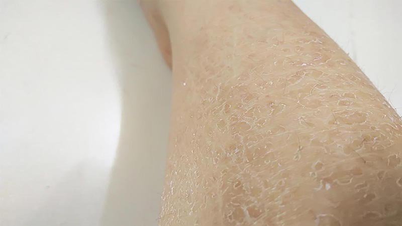 Top 20+ Triệt Lông Vĩnh Viễn Có Tốt Không Triệt lông vĩnh viễn có tốt không – Lợi và hại thế nào? 62 Vùng da triệt lông có thể bị khô và đóng vảy do bị tổn thương