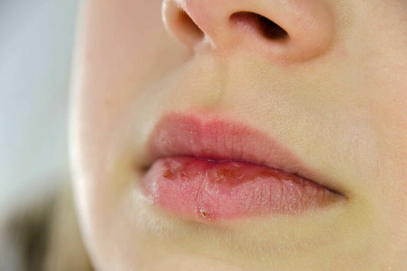 Top 20+ Tiêm Filler Cằm Bao Lâu Thì Đẹp Tiêm filler xong bị cứng phải làm sao? Nguyên nhân là gì? 26 Filler chất lượng kém có thể gây tình trạng cứng, ngứa sau khi tiêm