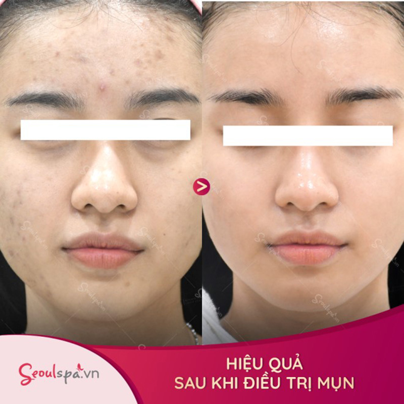 Hỗ trợ ngăn ngừa mụn xuất hiện và giúp da luôn tươi trẻ