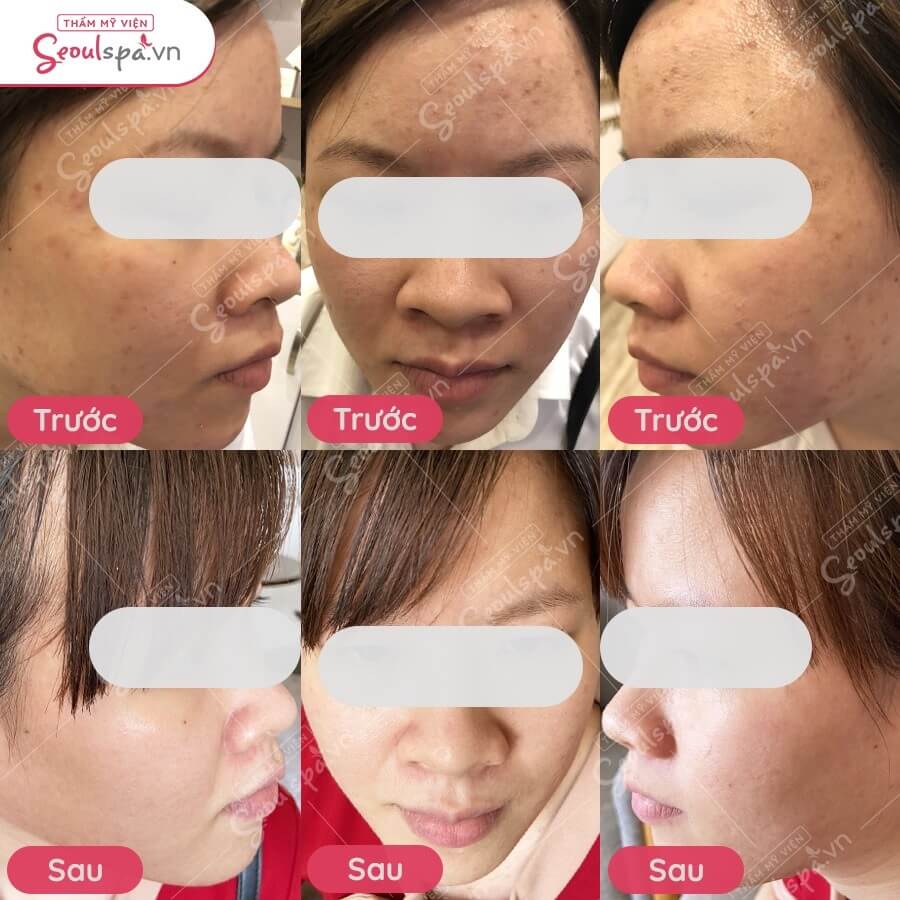 Hiệu quả khách hàng sử dụng dịch vụ điều trị mụn tơ tằm tại Thẩm mỹ viện Seoul Spa