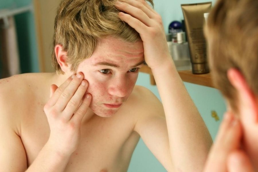 Spa điều trị mụn cho nam ở đâu?