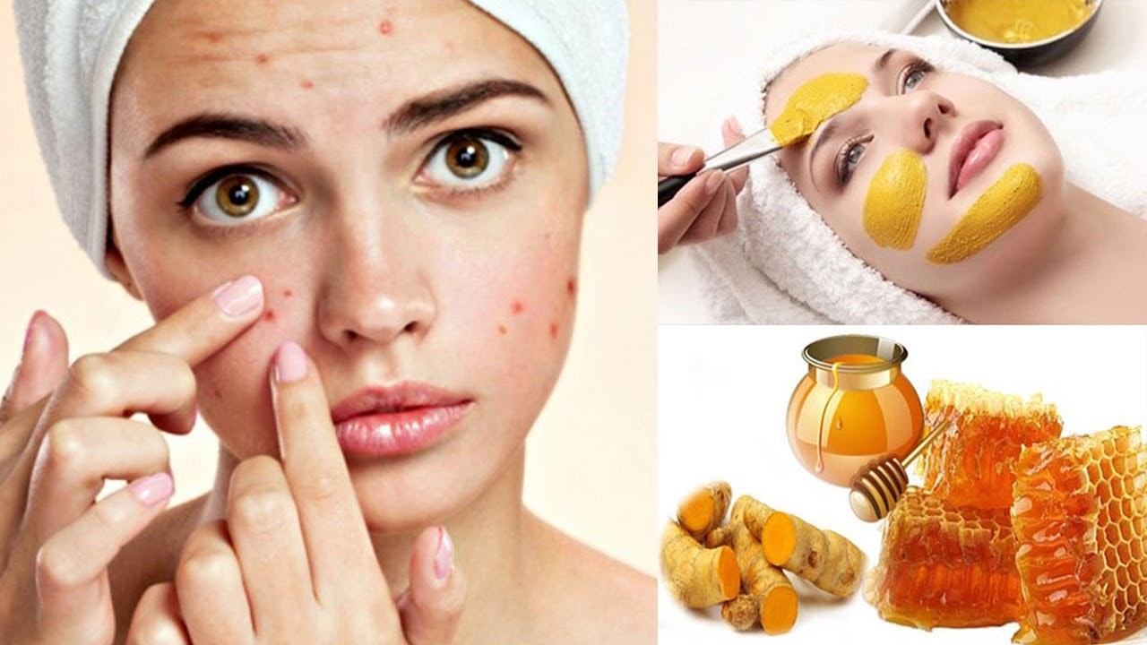 Trị sẹo mụn bằng mật ong thiên nhiên