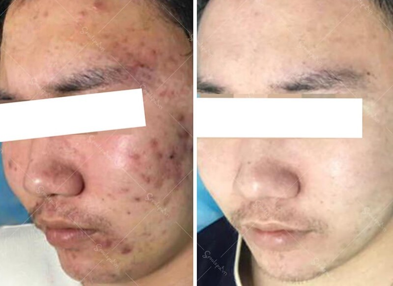 Hình ảnh khách hàng trước và sau khi trị thâm mụn tại Seoul Spa