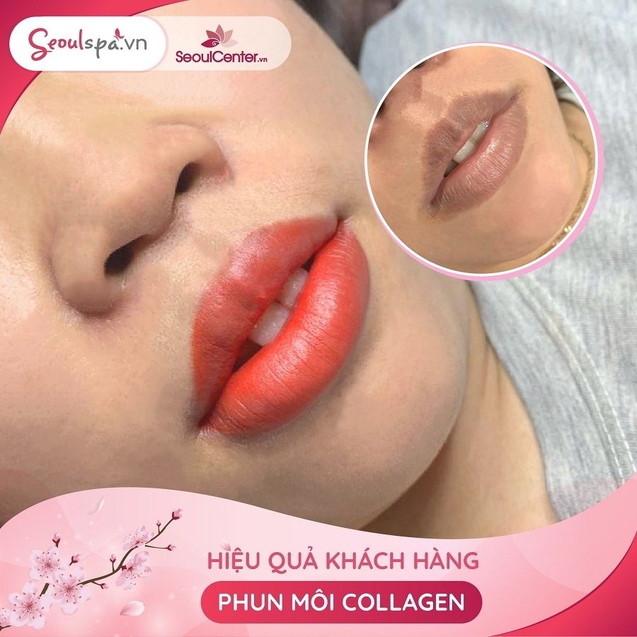 Sau khi phun môi collagen đôi môi của cô gái N.H.Giang đã không còn thâm tím, nhợt nhạt mà nó đã khoác lên một màu đỏ cam tươi tắn và căng mọng tự nhiên.