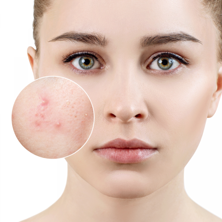 Top 20+ Kem Trị Mụn Ở Nhà Thuốc Tây Cách làm kem trị mụn bằng thuốc tây an toàn nhất 29 Mụn là vấn đề thường gặp của nhiều người, đặc biệt là các chị em phụ nữ