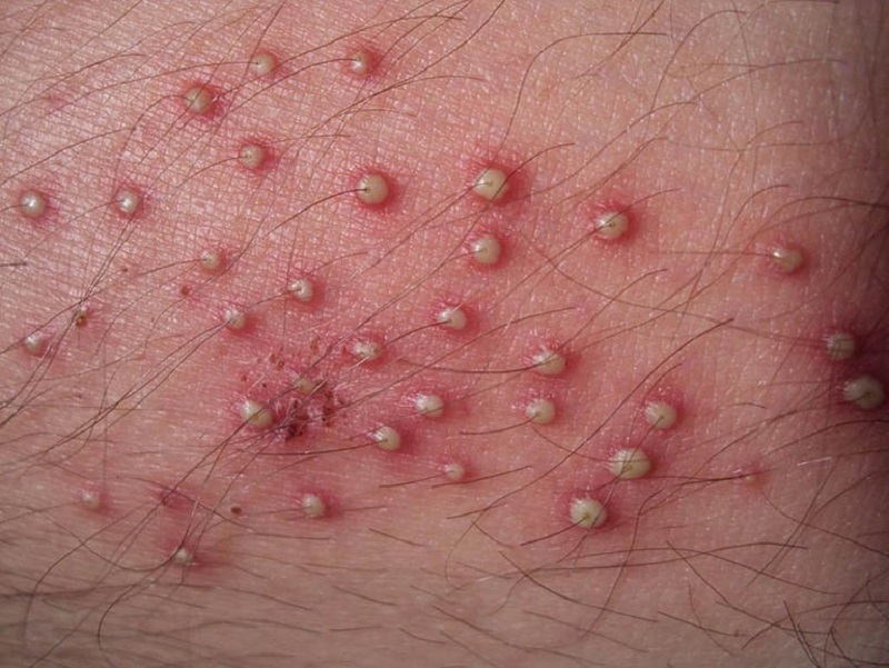Mụn ở nách viêm mủ để lâu ngày rất nghiêm trọng