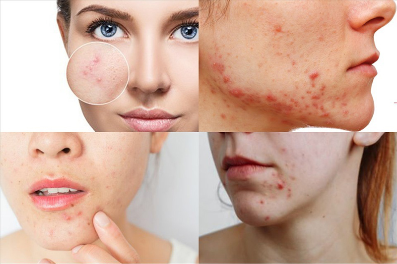 Các bạn áp dụng nhiều phương pháp trị mụn nội tiết khác nhau