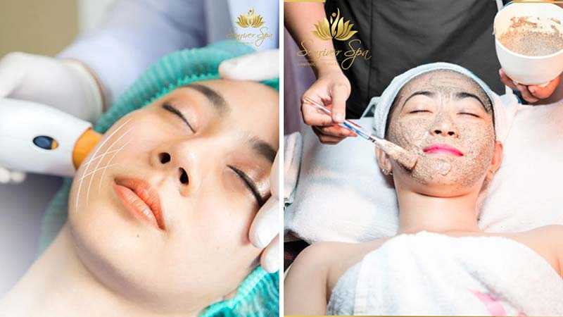 Điều trị mụn dứt điểm tại Sen River Spa