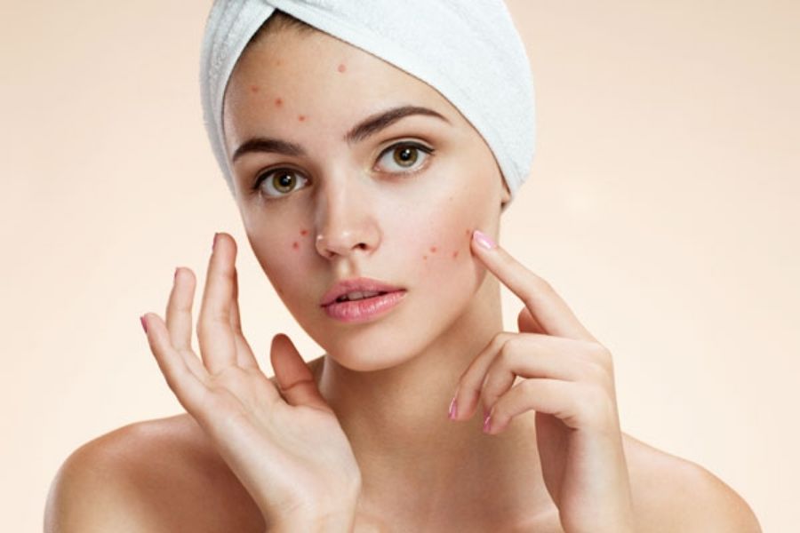 Bị mụn vẫn có thể ăn khoai tây nhưng ăn ở mức vừa phải