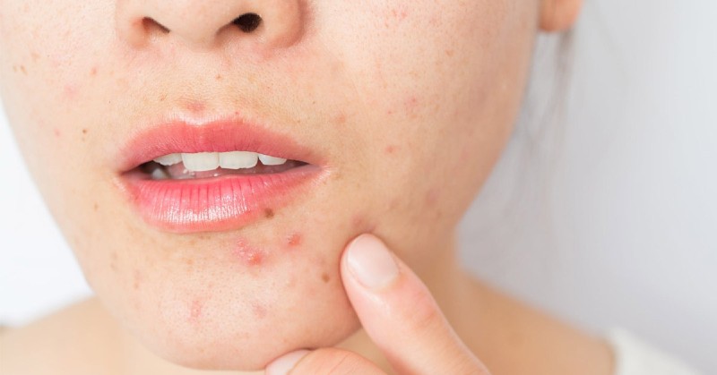 Bạn có thể trị thâm mụn nhẹ bằng lá trầu không