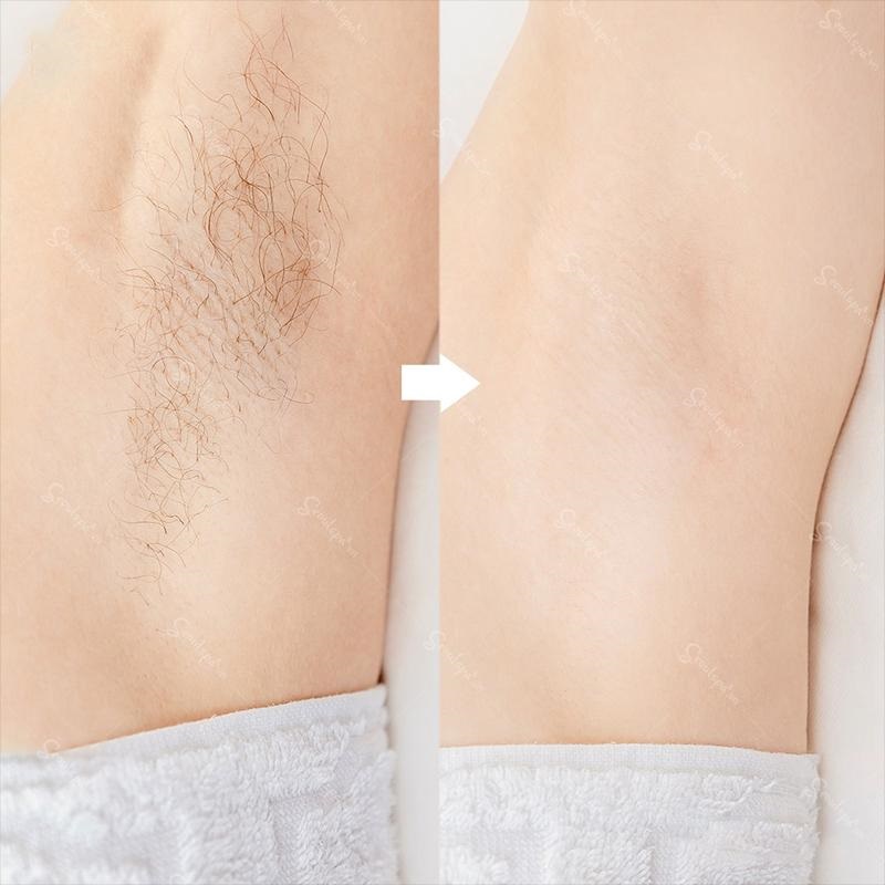 Triệt lông tại Seoul Spa lông không mọc lại trong thời gian dài