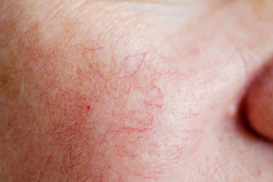 Top 20+ Kem Nghệ Herbal Thái Lan Có Phải Kem Trộn Không Tác hại của kem trộn chứa Corticoid– Sản phẩm hủy hoại làn da 28 Kem trộn làm giãn mao mạch da