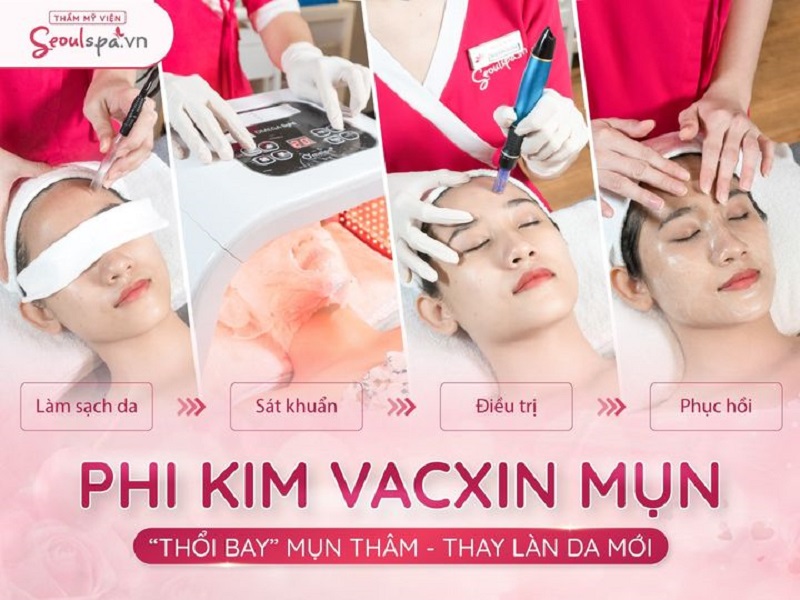 Quy trình điều trị mụn chuẩn Y Khoa bằng công nghệ phi kim vaccin mụn loại bỏ sạch mụn