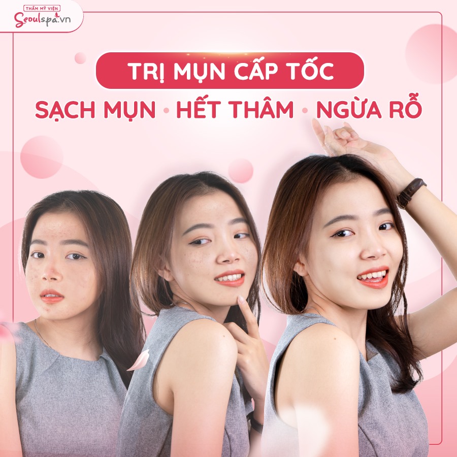 Trị mụn hiệu quả - an toàn cao tại Seoul Spa