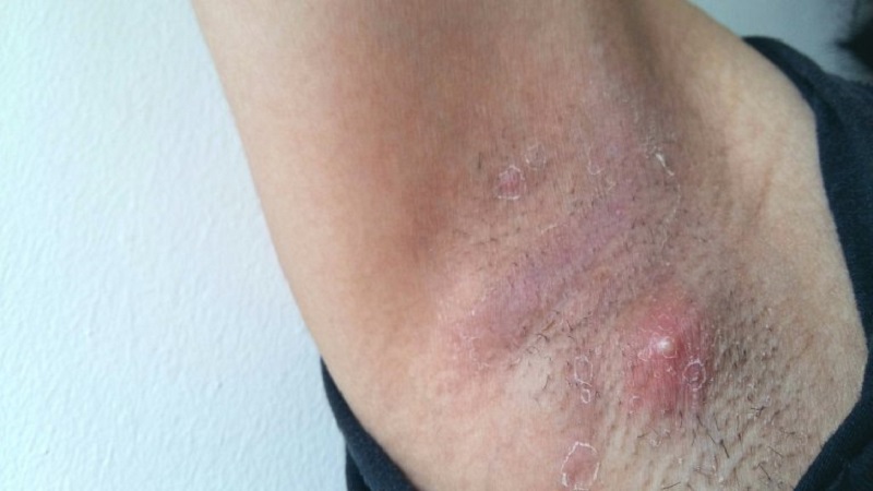 Mụn nhọt ở nách đang phát triển, viêm nhiễm