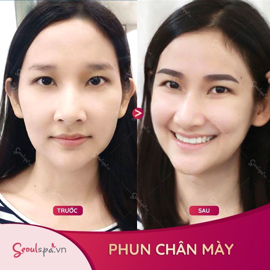 Chân mày chị khách N.H. Trân hầu như không có dáng, sợi mày quá thưa thớt, mọc không theo nếp khiến gương mặt chị thiếu cân đối, nhợt nhạt nhưng chỉ sau 30 phút phun thẩm mỹ chị đã sở hữu chân mày cực đẹp và tự nhiên.