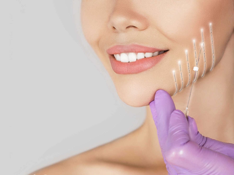 Có nên căng chỉ collagen không?