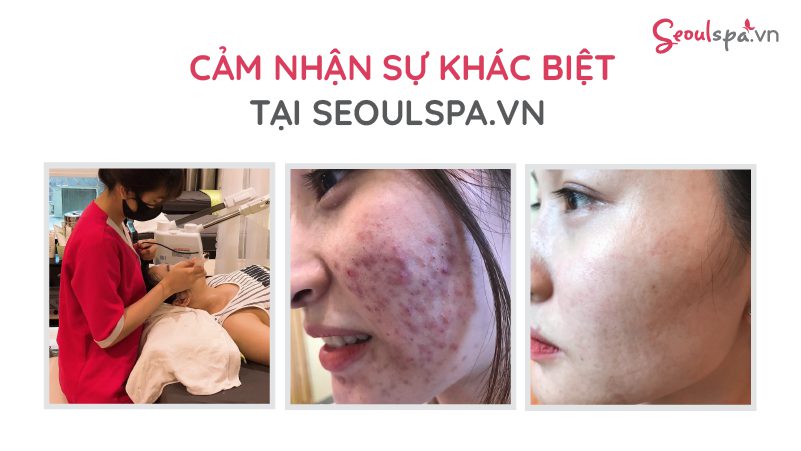 Làn da của khách hàng trước và sau khi sử dụng dịch vụ trị mụn tại Seoul Spa