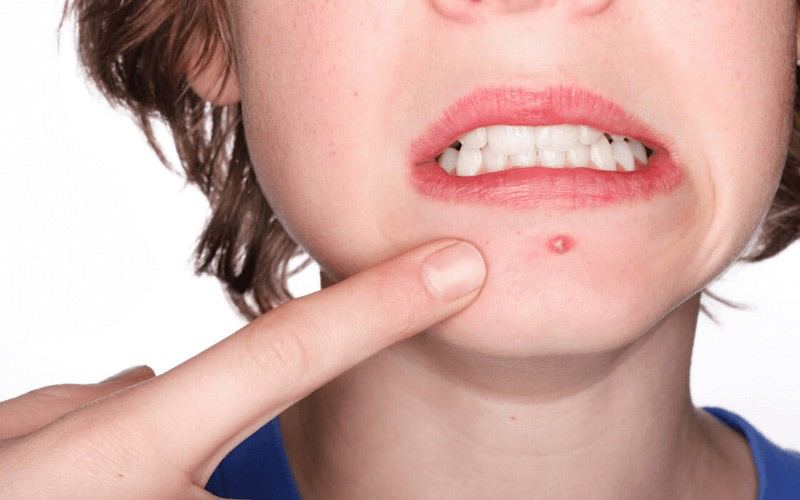Chôm chôm chứa nhiều đường nên ăn nhiều sẽ gây mụn