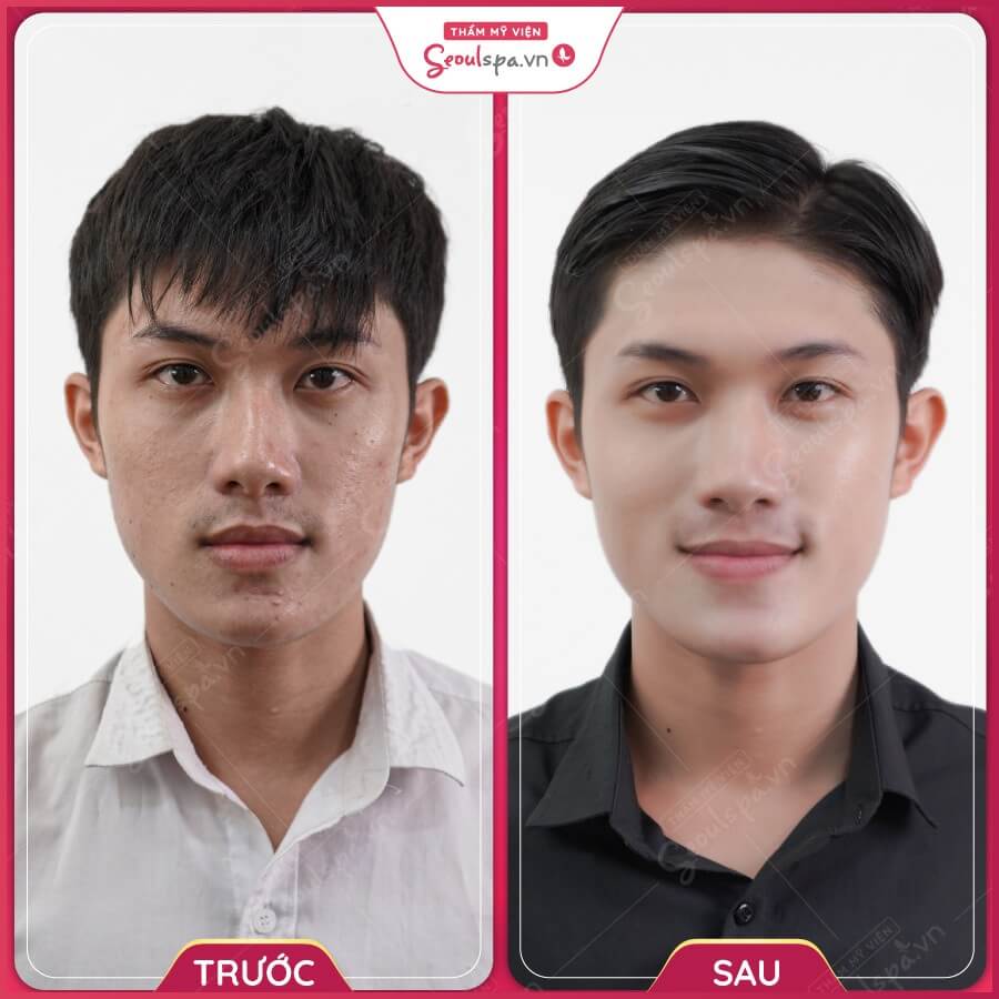 Công nghệ trị mụn Acne Spectra Korea mang lại hiệu quả cao cho khách hàng