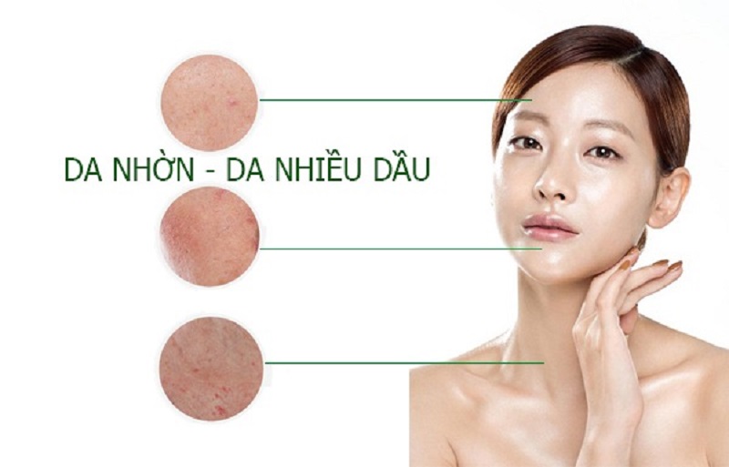 Da dầu nhiều dầu là loại da dễ hình thành mụn nhất