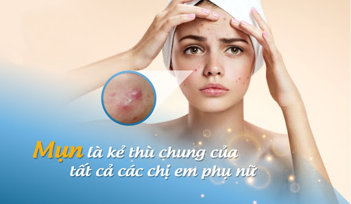 Những loại mụn sưng mụn viêm đều có nguy cơ hình thành sẹo