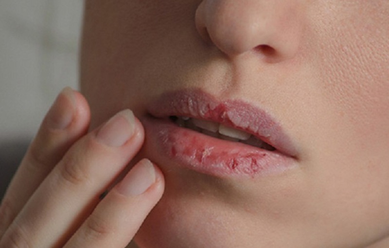 Top 20+ Thuốc Bôi Acyclovir Stada Cream Có Tác Dụng Gì Acyclovir bôi môi có tác dụng gì? Cách bôi acyclovir sau phun môi 25 Môi có thể bị khô khi bôi thuốc kháng sinh Acyclovir