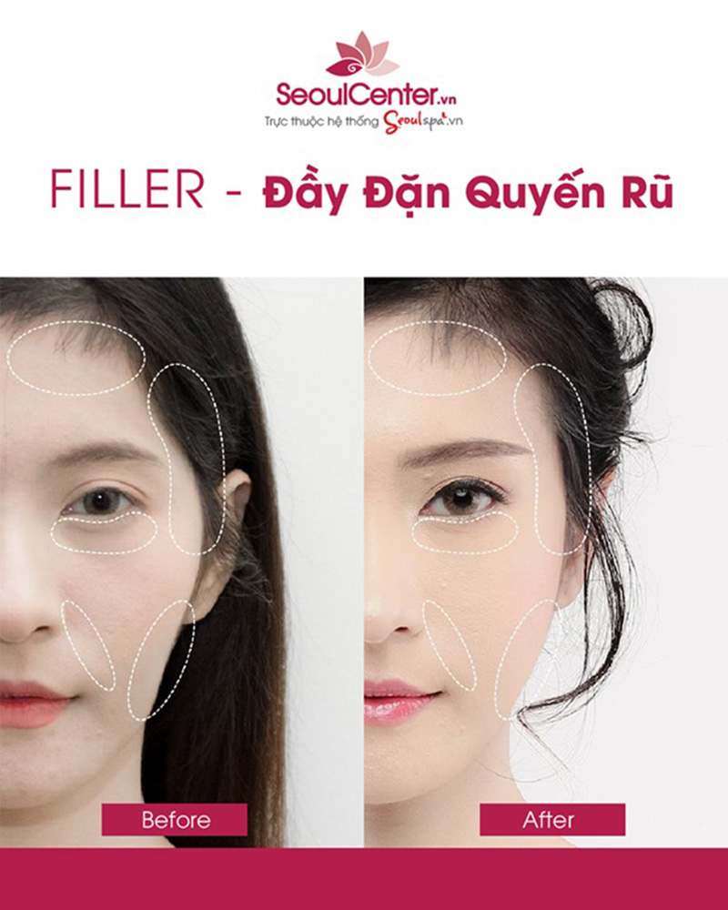 Top 20+ Tiêm Filler Cằm Bao Lâu Thì Đẹp Tiêm filler xong bị cứng phải làm sao? Nguyên nhân là gì? 36 Mang đến hiệu quả làm đẹp nhanh chóng và an toànMang đến hiệu quả làm đẹp nhanh chóng và an toàn