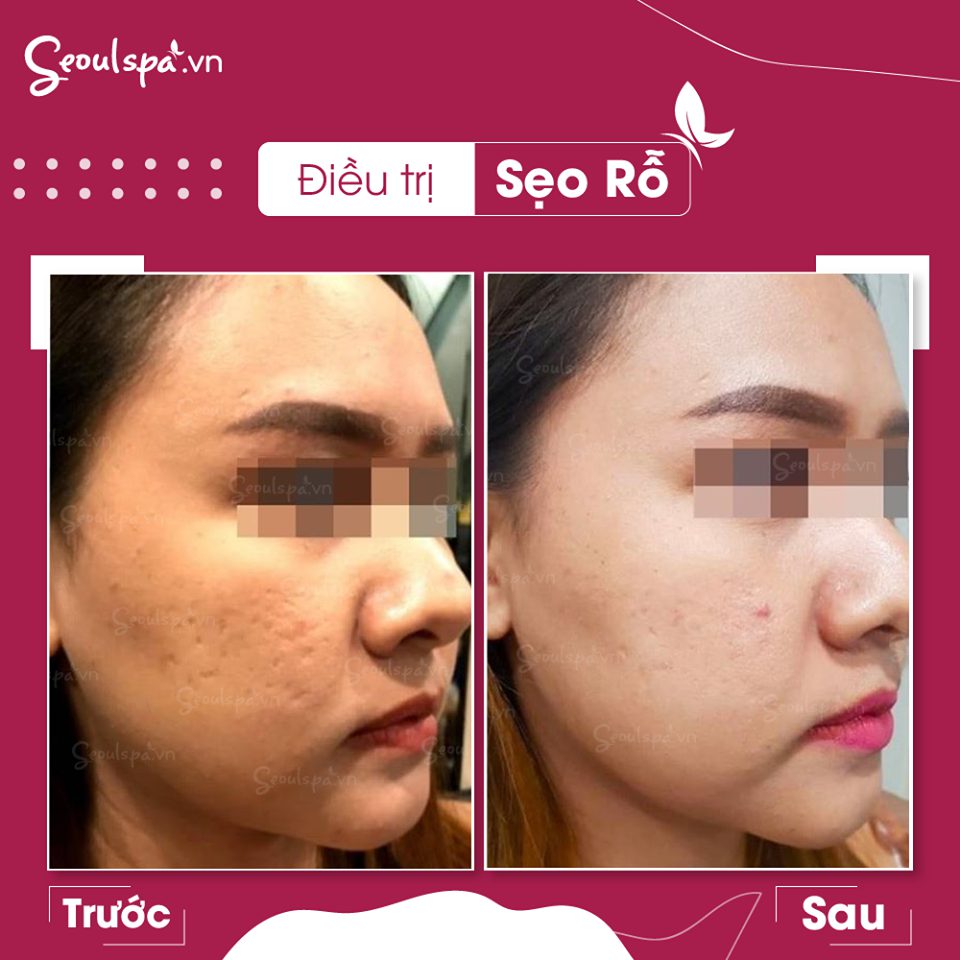 Sẹo do mụn chỉ có thể cải thiện 90%