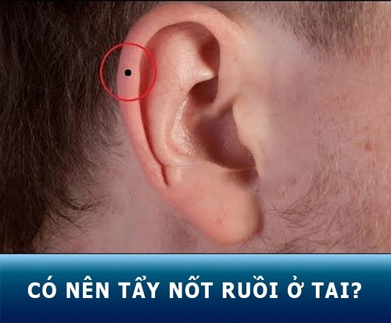 Có nên tẩy nốt ruồi không?