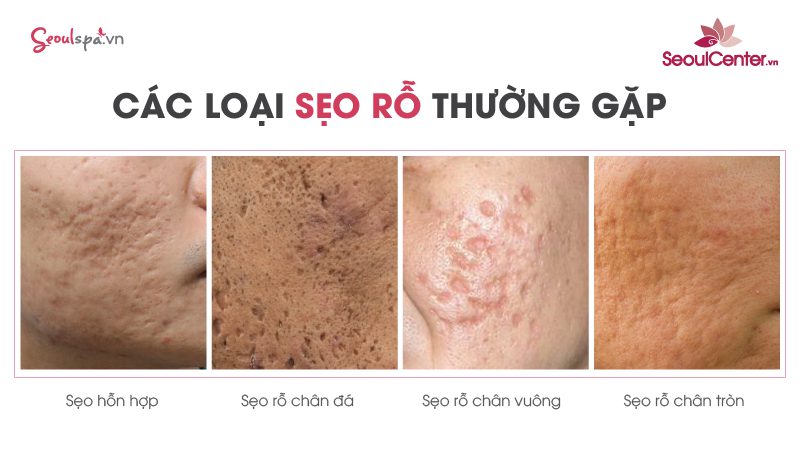 Top 20+ Mặt Bị Rỗ Có Chữa Được Không “Tuyệt chiêu” giúp phục hồi da mặt bị rỗ hiệu quả | SeoulSpa.Vn 48 Một số dạng sẹo rỗ thường gặp