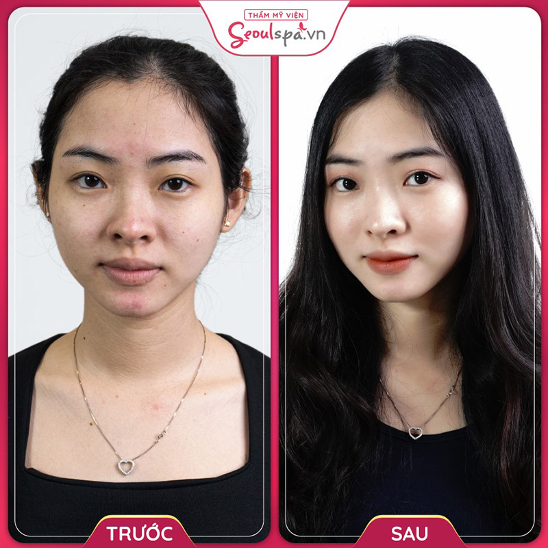 Cần chú ý quá trình chăm sóc da để có được hiệu quả trẻ hóa da tốt nhất
