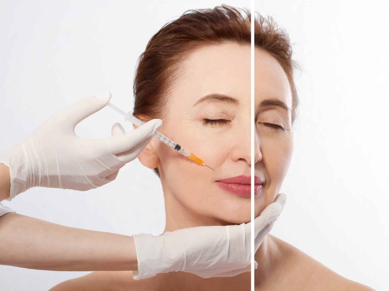 Căng da trán bằng cách tiêm filler