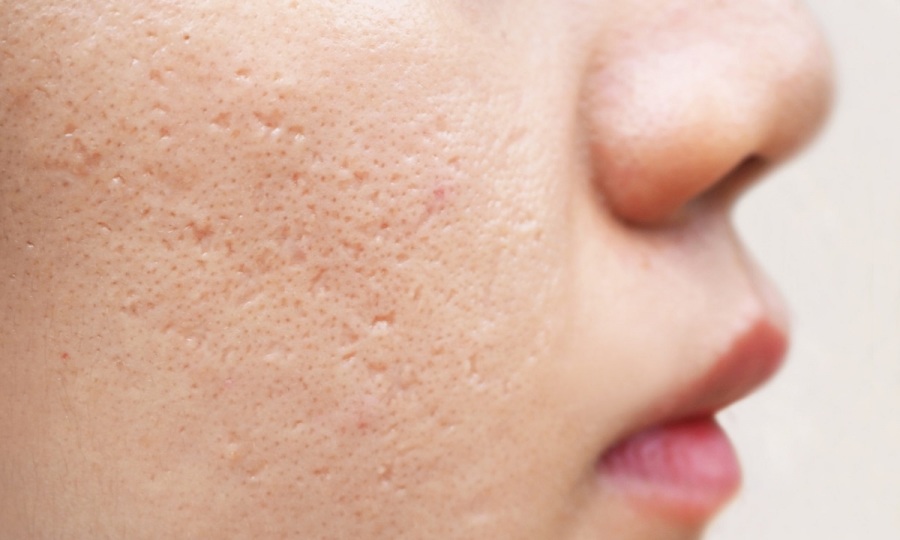 Sẹo rỗ do mụn gây ra