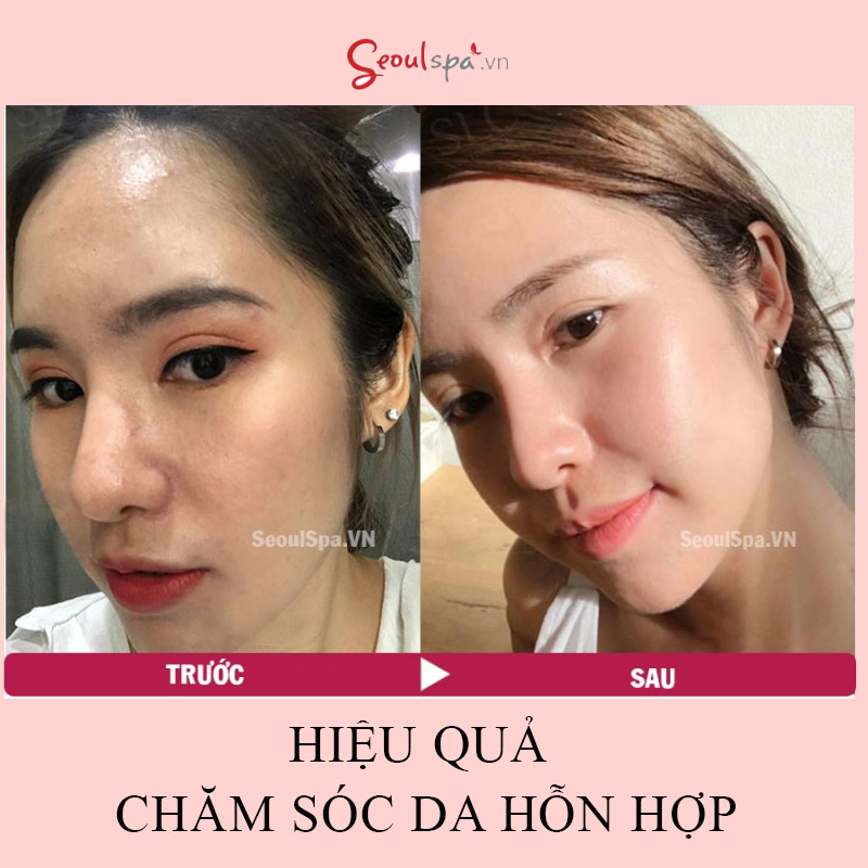 Khách hàng sau khi chăm sóc da tại SeoulSpa.Vn