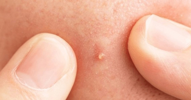Top 20+ Cách Trị Mụn Đầu Trắng Ẩn Dưới Da Cách trị mụn đầu trắng ẩn dưới da siêu hiệu quả bằng tự nhiên 51 Có nên thực hiện nặn mụn đầu trắng